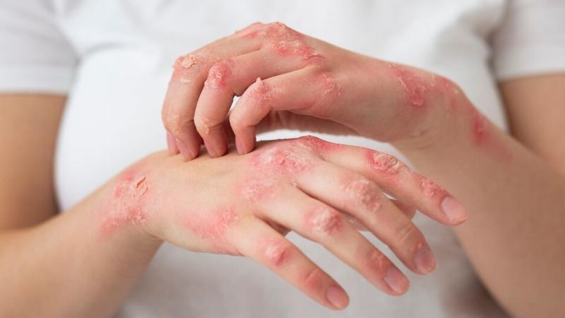 eczema