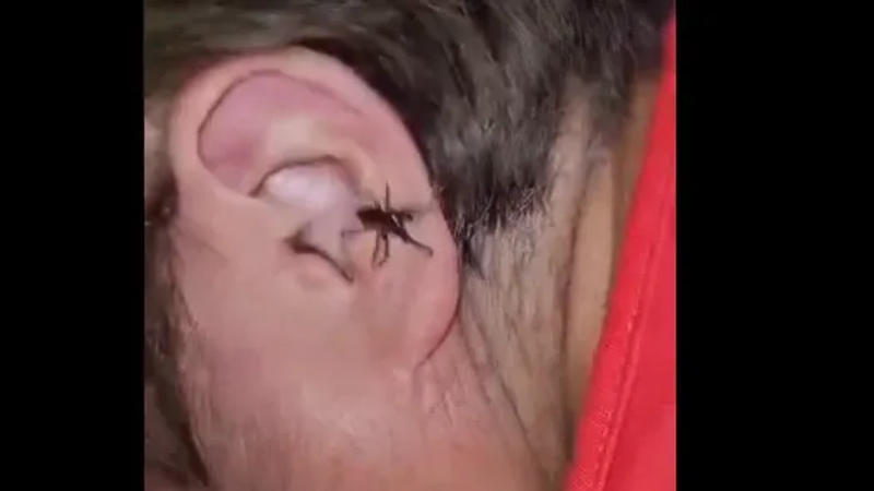 Spider emerges from man's ear, sparks online Frenzy