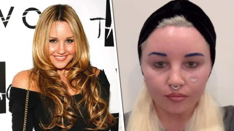 Amanda Bynes  blepharoplasty 