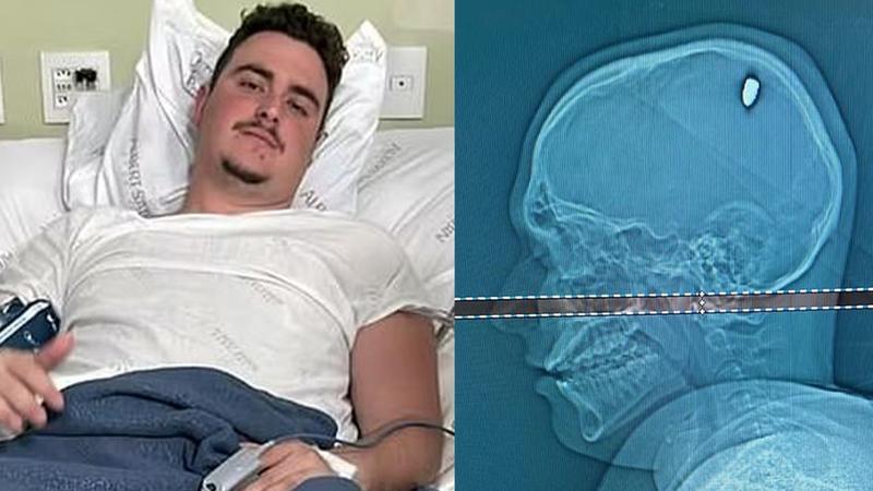 Brazilian Man, 21, Parties For 4 Days With Bullet Lodged In His Head