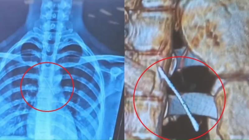 Doctors Remove Needle From Teen's Lung 