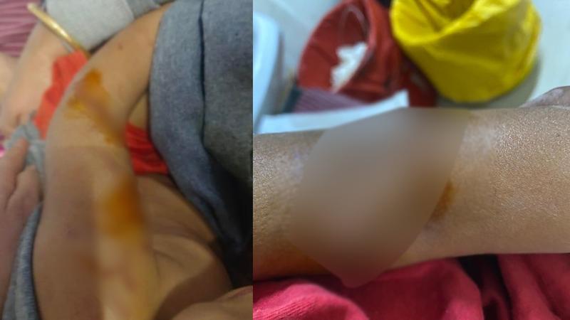 DISTURBING: 4-Year-Old Seriously Injured in Bengaluru as American Pitbull Attacks