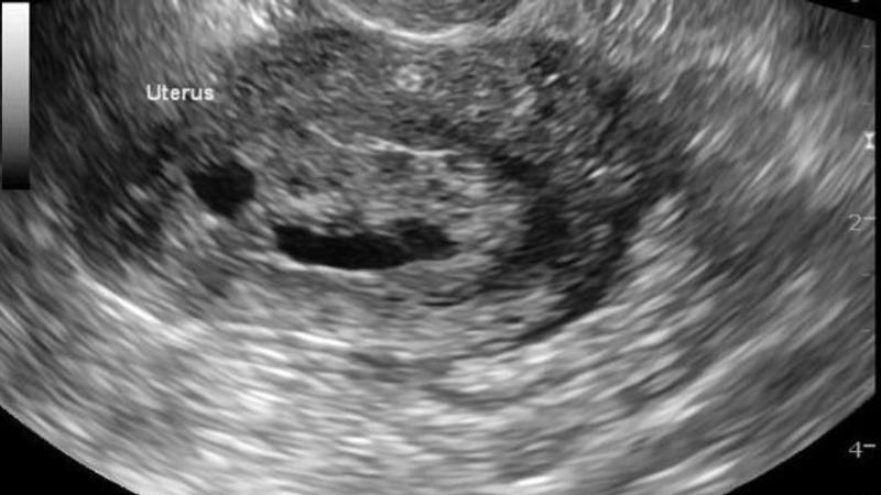 Cystic hyperplasia