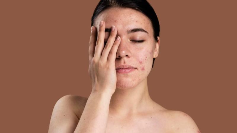 Hyperpigmentation Remedies