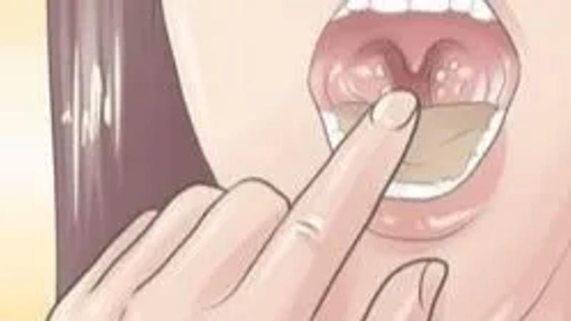 7 ways to cure your Tonsillitis 